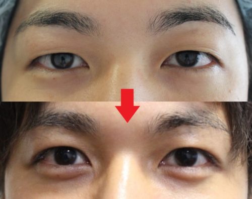 切らない眼瞼下垂治療で男も二重に
