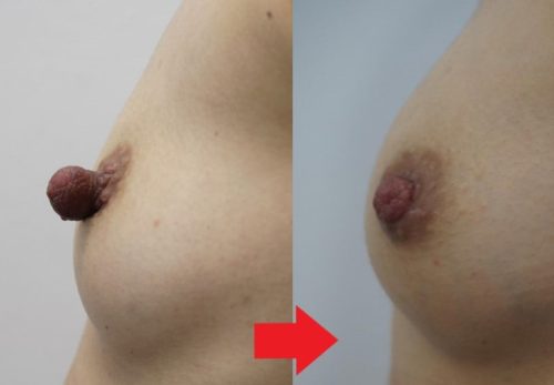 豊胸よりも乳頭縮小?