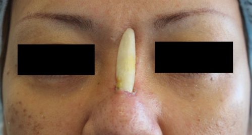 25767鼻整形後にできなくなること:術後の生活変化と対策を徹底解説