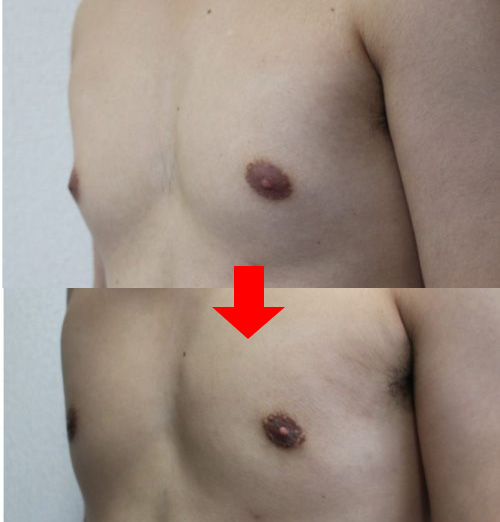 女性化乳房の治療方法について