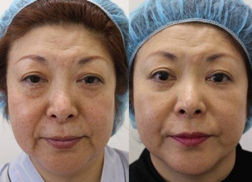 フェイスリフト手術|スプリングスレッドとの併用で満足度アップ