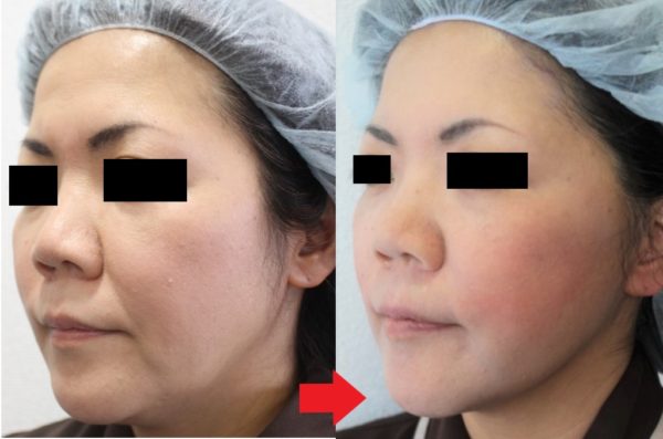 46歳女性 フェイスリフト手術の詳細経過