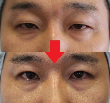 切らない眼瞼下垂治療