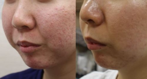 効果抜群のニキビ治療「アグネス」