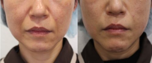 糸による引き上げは効果がない？！【スプリングスレッドの本当の効果】