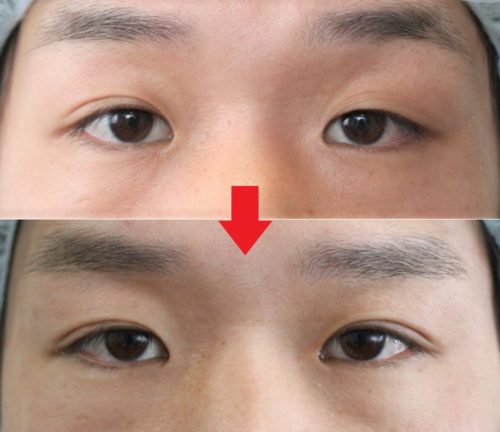 片目だけ眼瞼下垂