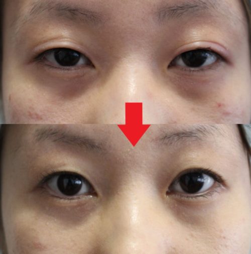 隠れ眼瞼下垂は切らない眼瞼下垂治療で目ぱっちり！