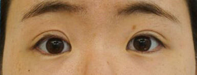 切らない眼瞼下垂治療 治療後