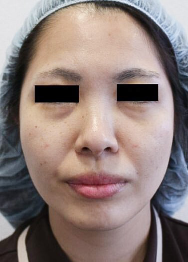 フェイスリフト手術前