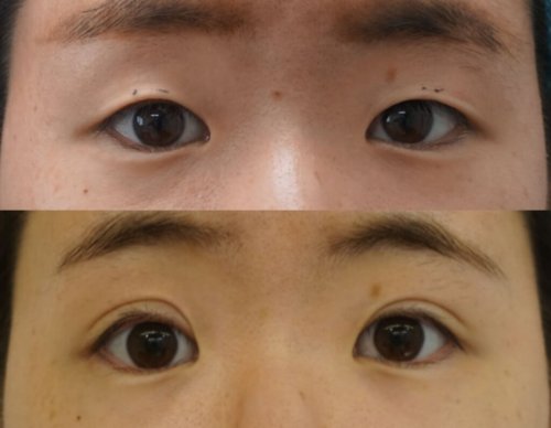 切らない眼瞼下垂治療で目ぱっちり！