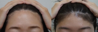 女性薄毛のヘアーバース注射