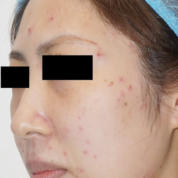 プロアクティブはニキビに効果があるのか？