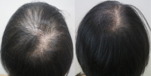 女性薄毛治療｜元神医師開発のヘアーバース注射で発毛促進【症例あり】
