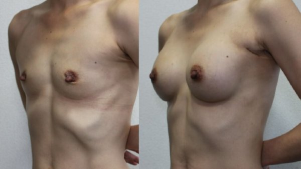 乳腺下バッグ豊胸手術1か月の経過