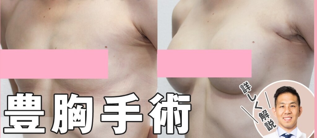 豊胸バッグの動画解説！