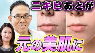 ニキビ跡も綺麗な肌に改善！フラクショナルレーザー