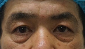 browliftbefore 眉下切開治療前