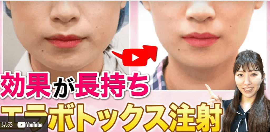 エラボトックス注射の動画解説