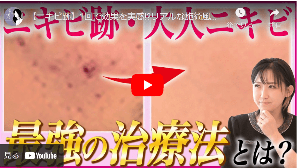 アグネス治療のモニター動画