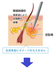 アグネスイラスト治療前