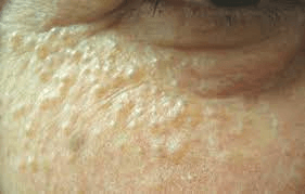 “Bumps Around the Eyes: What Are They? ③Could it be Eccrine Hidrocystoma?”