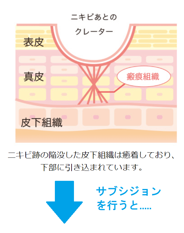 ニキビ跡を見事に治療！サブシジョン治療のクリニック選びの秘訣