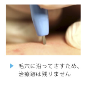 アグネス治療跡