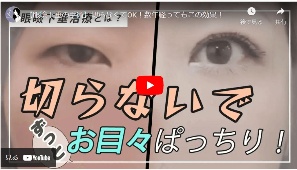 切らない眼瞼下垂の動画解説