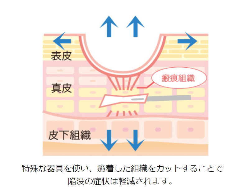 サブシジョンによるニキビの瘢痕治療【概要編】