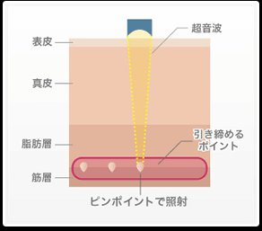 ウルセラ原理