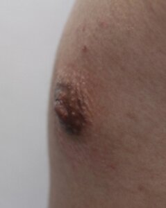 男性乳頭縮小手術術後