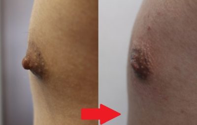 男の乳頭縮小手術の方法