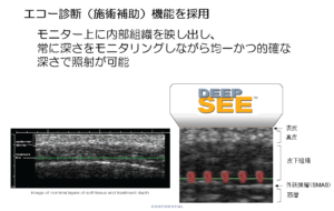 ウルセラの画像補助