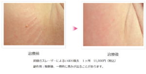 胸のブツブツのイボの症例写真