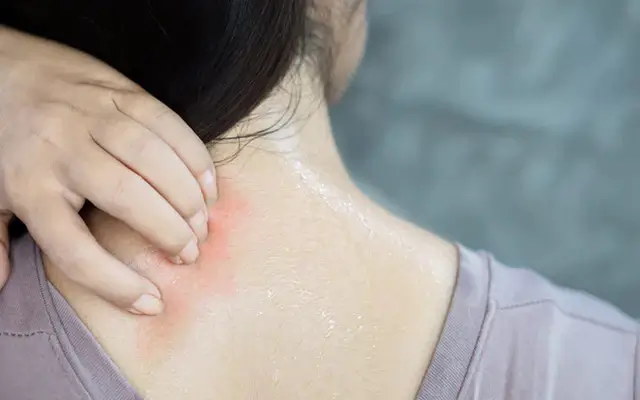 首の後ろの汗は多汗症による？あせもの要因にも