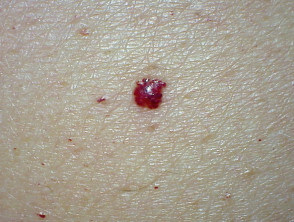 老人性血管腫