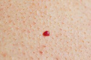 cherry angiomaさくらんぼ血管腫