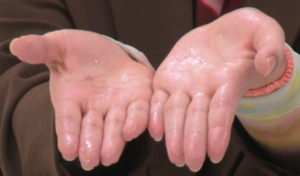 手掌多汗症の状態