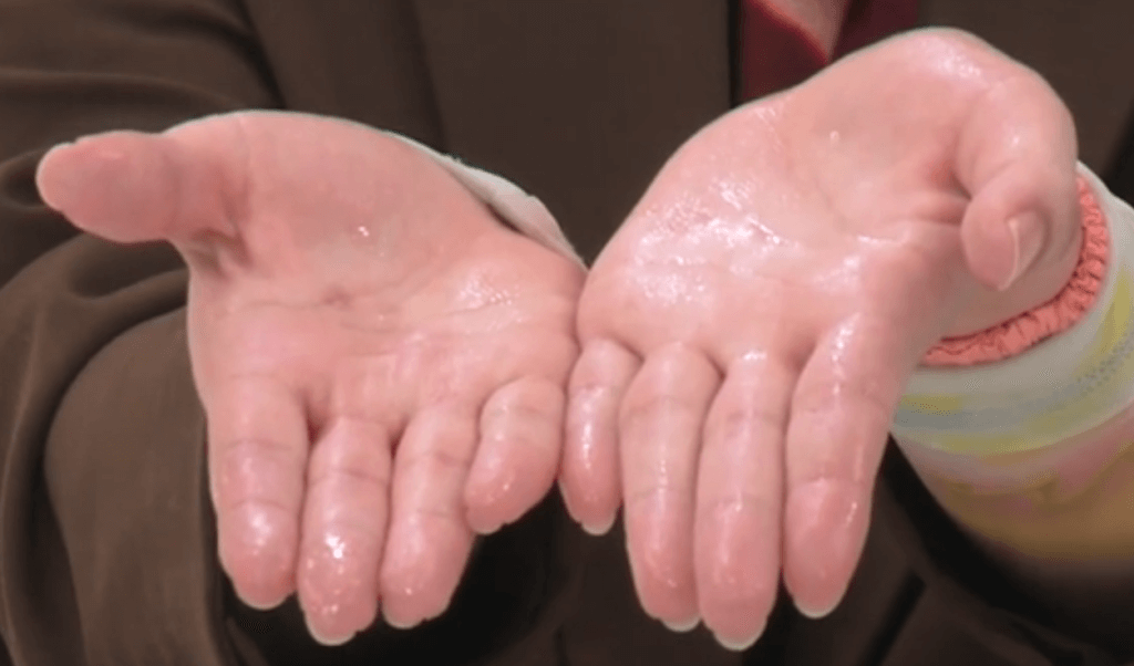 アベマTVで手掌多汗症を特集！なぜボトックスが紹介されないのか？