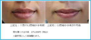 口唇縮小手術の手術前後
