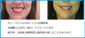 ガミースマイル治療前後