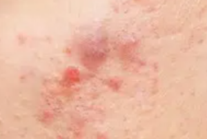 紫にきび