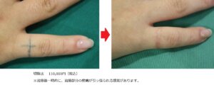 指のタトゥー切除指治療前後