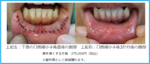 口唇縮小手術の傷跡