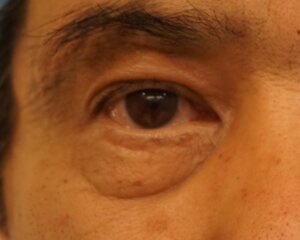 眉下リフト術後1か月
