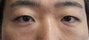 眉下切開男術前