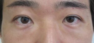 眉下切開男術後3か月