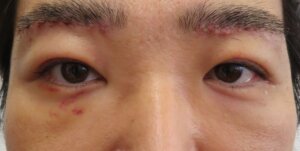眉下切開男術後1週間