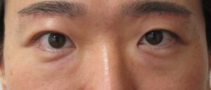 眉下切開男術後1か月