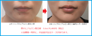 リップフィラー唇ヒアルロン酸注入前後